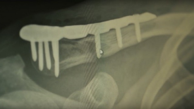 MTB Injuries: The Broken Collarbone | Pain vs Reward