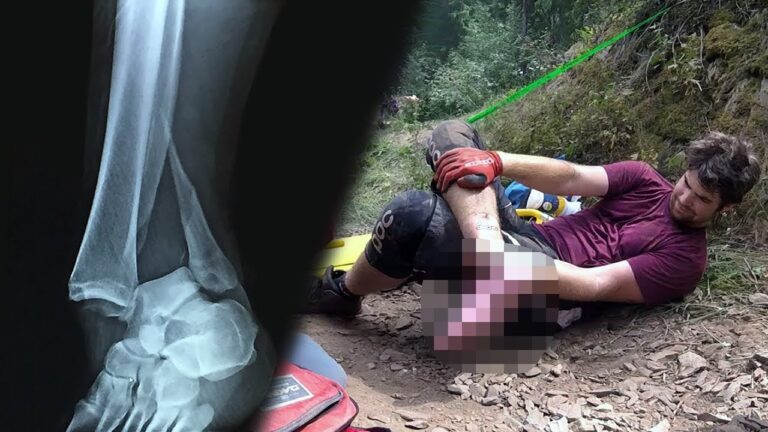 #WipeoutWednesdays: Broke My Ankle Downhill Mountain Biking (Graphic)