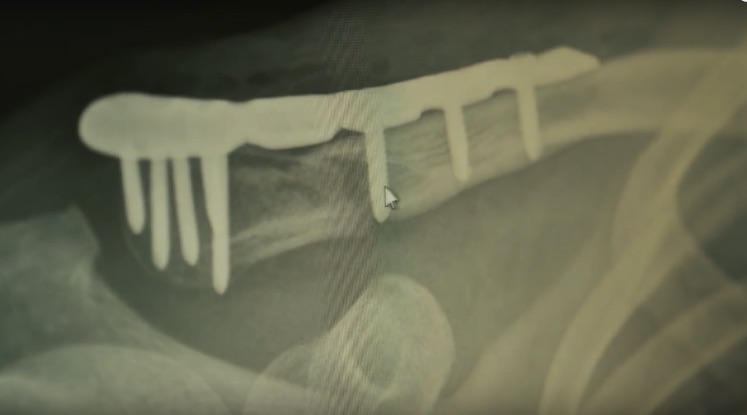 MTB Injuries: The Broken Collarbone | Pain vs Reward